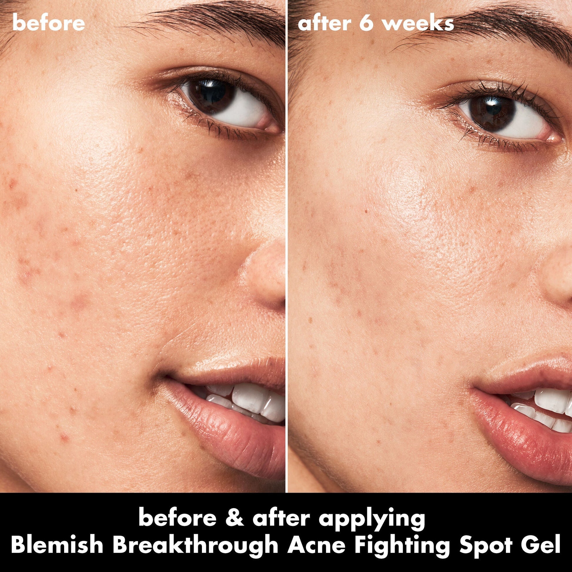 blemish-breakthrough-acne-fighting-spot-gel-f6 0326_EDU_BB_SpotGel_BA_ISABELLA.jpg
