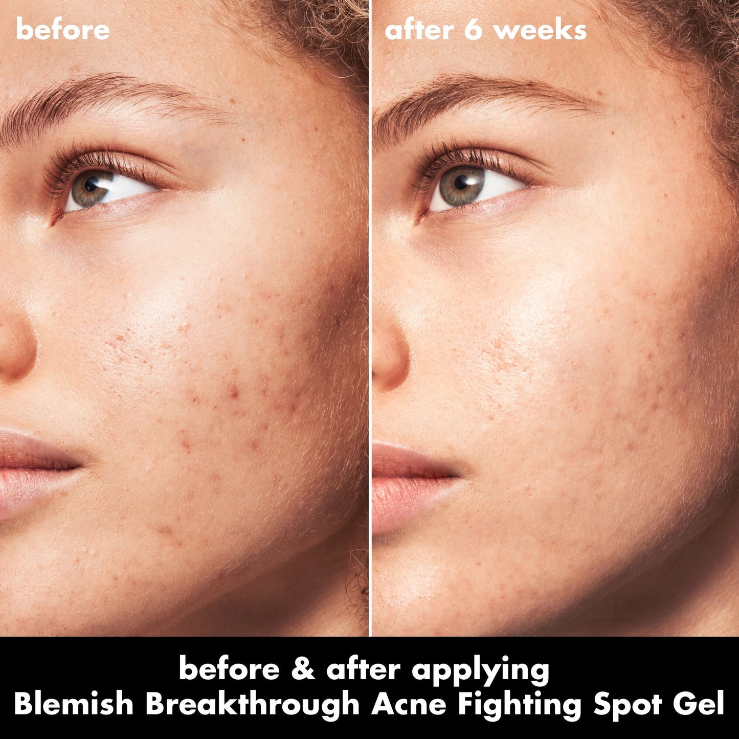 blemish-breakthrough-acne-fighting-spot-gel-f6 0326_EDU_BB_SpotGel_BA_MARLEY.jpg