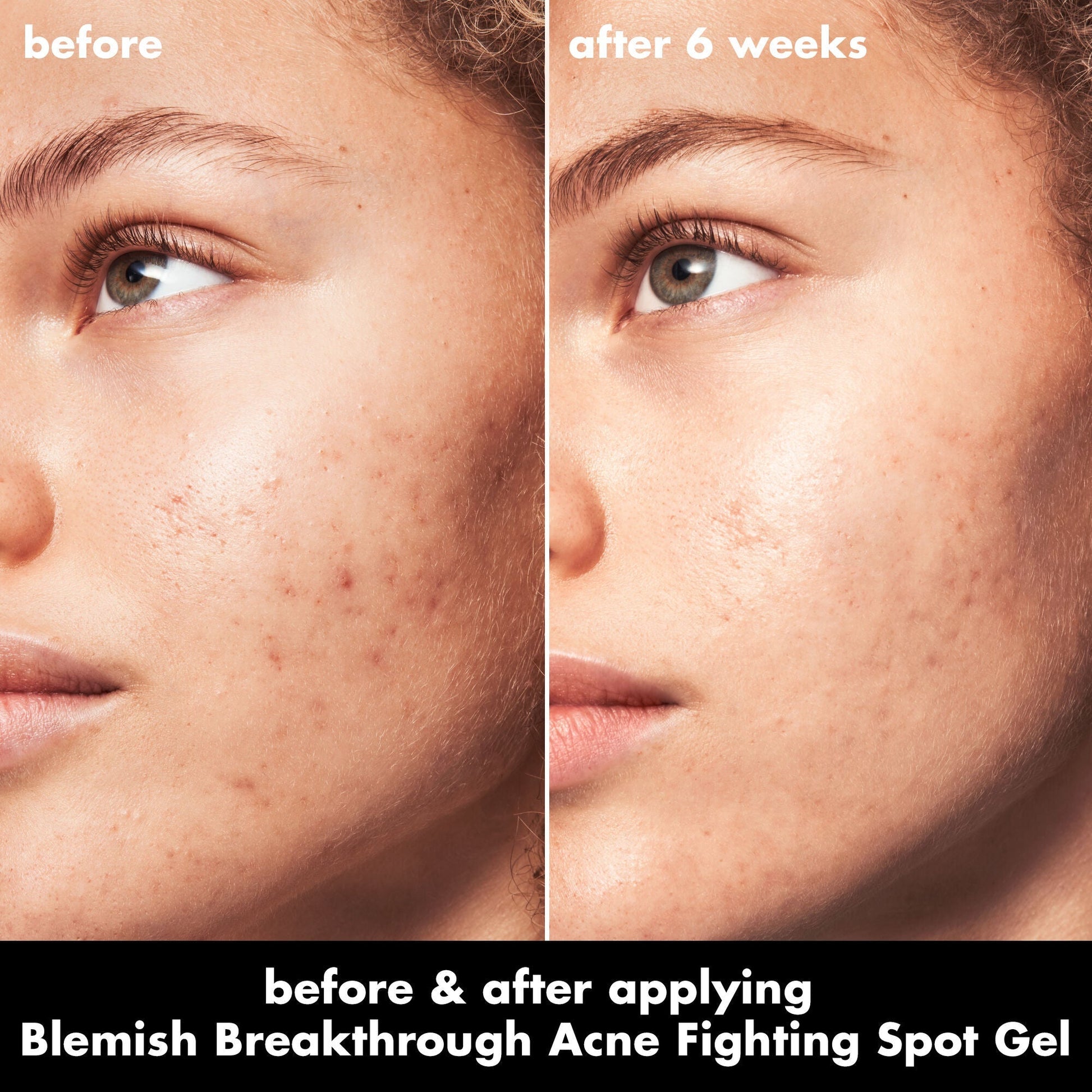 blemish-breakthrough-acne-fighting-spot-gel-f6 0326_EDU_BB_SpotGel_BA_MARLEY.jpg