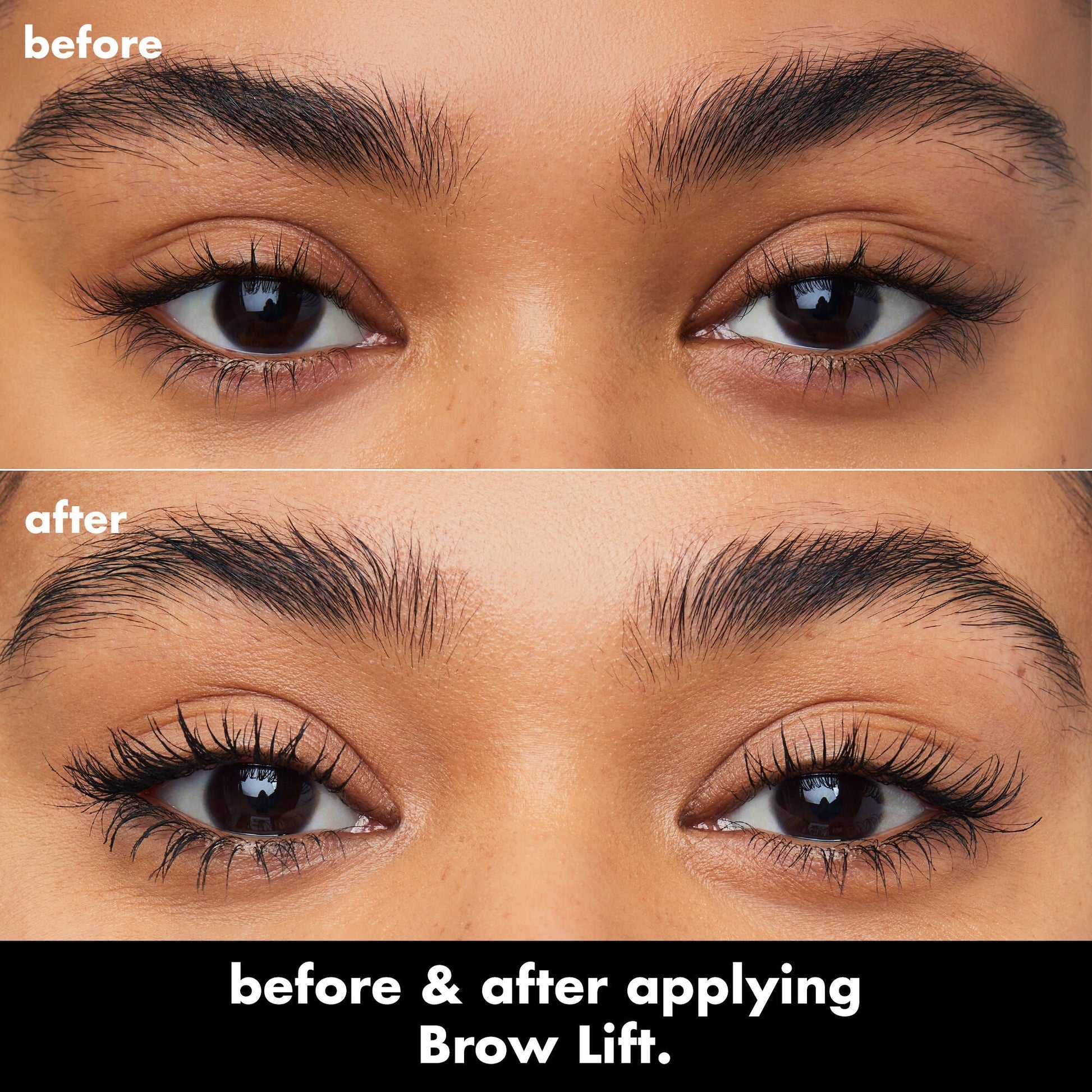 brow-lift-z5 0326_EDU_BrowLift_BA.jpg