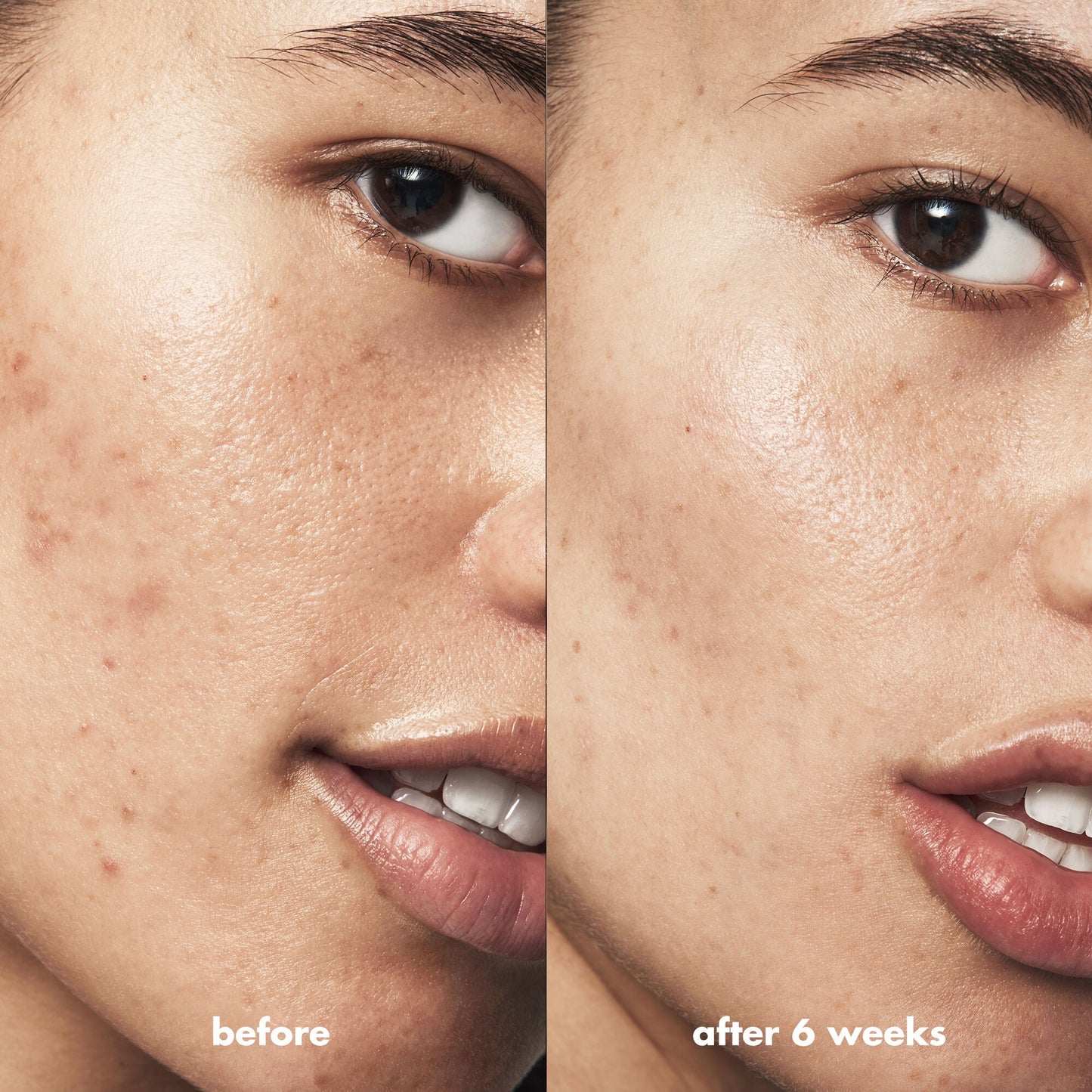 blemish-breakthrough-acne-calming-water-cream-mini-k8 Acne_PDP_Isabella_Before_After_f0d452cd-72f5-4bb8-a6df-0b3cc23143ef.jpg