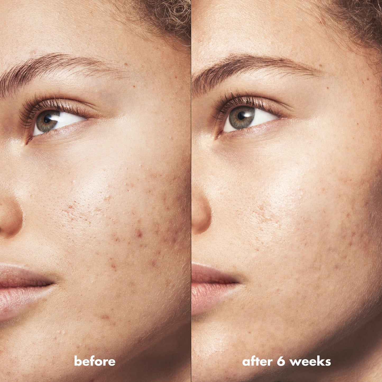 blemish-breakthrough-triple-acid-resurfacing-serum-g9 Acne_PDP_Marley_Before_After_1a95cac5-0af6-43b6-a936-d0bacbdec0bf.jpg